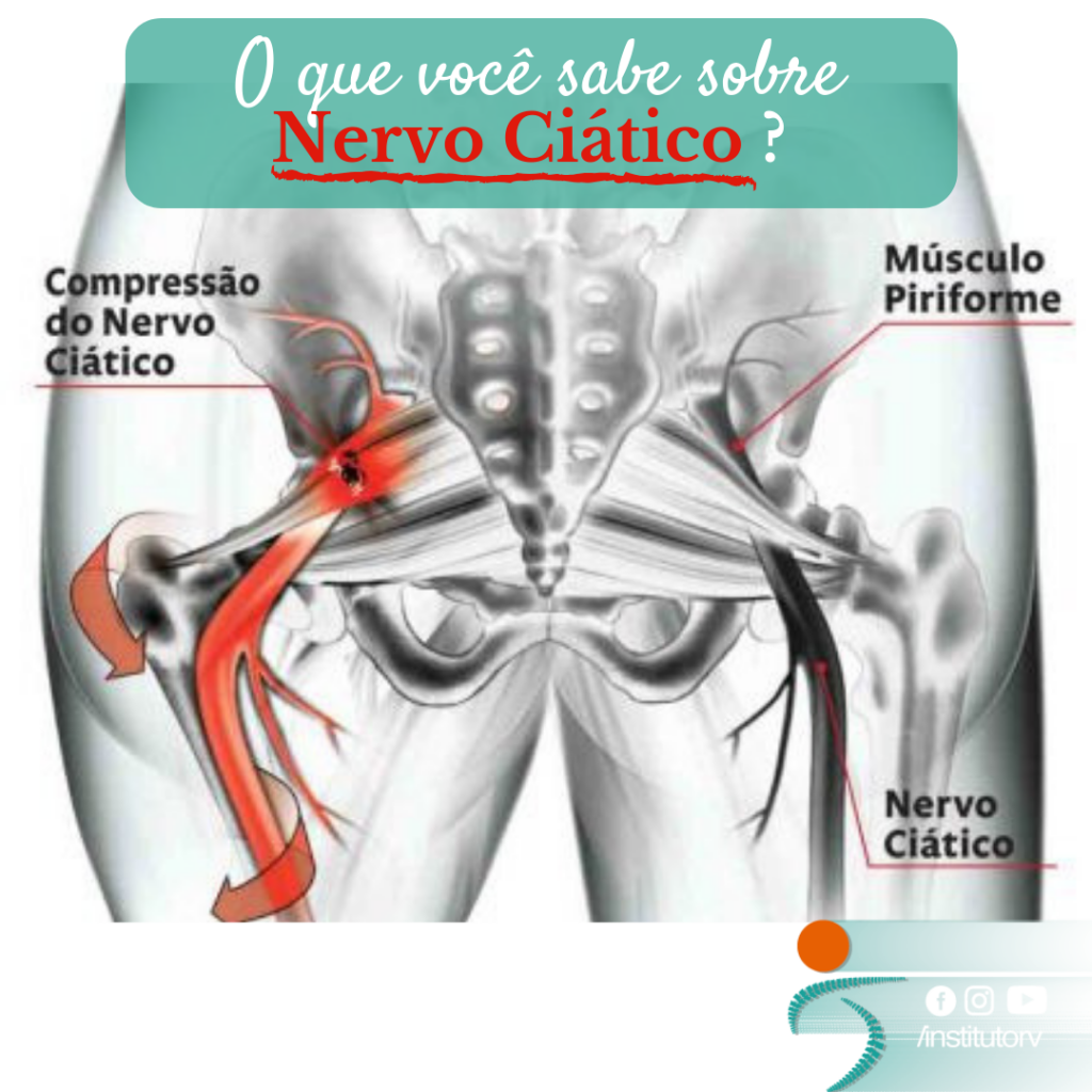 Tratamento definitivo para Nervo Ciátio