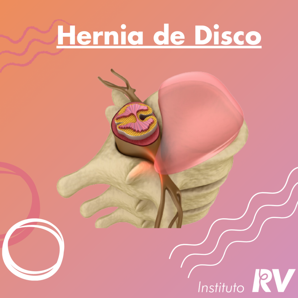 Tratamento Hérnia de disco em São Paulo