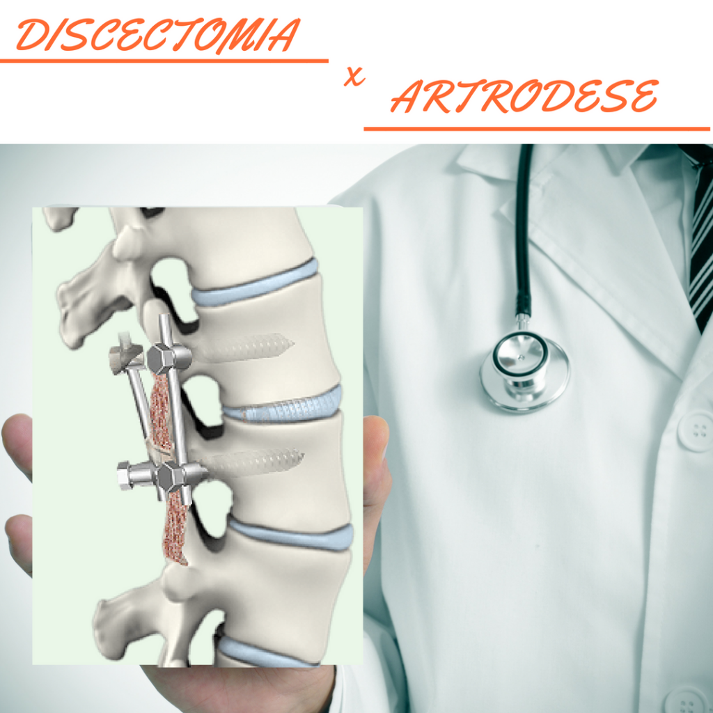 Discectomia x Artrodese para hérnia de disco? - Instituto RV