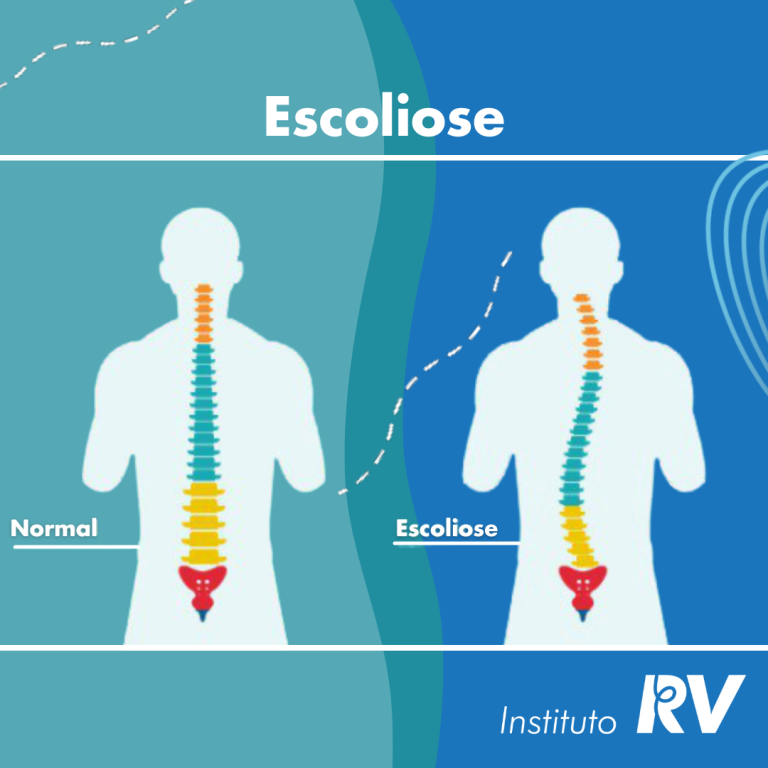 Tratamento da Escoliose