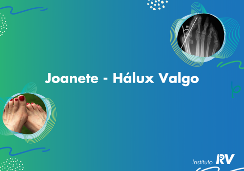 Tratamento Joanete
