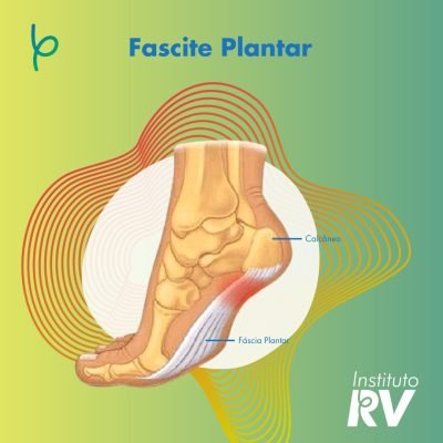 Fascite Plantar